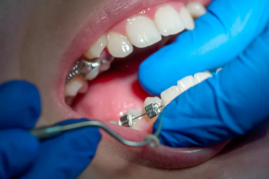 مراقبتهای بعد از ارتودنسی