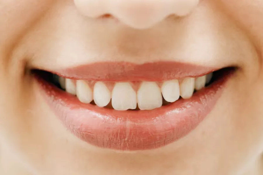 لکه دار شدن کامپوزیت دندان